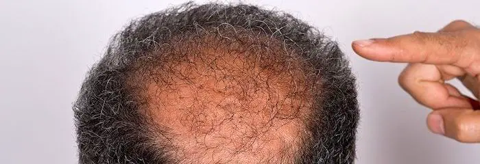 Man with moderate hair loss, due to poor eating habits.